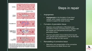 z
Steps in repair
1. Angiogenesis
 Angiogenesis is the formation of new blood
vessels, which supply nutrients and oxygen
needed to support the repair process
2. Formation of granulation tissue
 Migration and proliferation of fibroblasts and
deposition of loose connective tissue, together with
the vessels and interspersed leukocytes, form
granulation tissue.
 The term granulation tissue derives from its pink,
soft, granular gross appearance, such as that seen
beneath the scab of a skin wound.
3. Remodelling of connective tissue
 Maturation and reorganization of the connective
tissue produce the stable fibrous scar
 