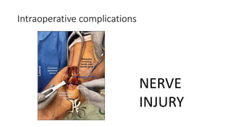 Intraoperative complications
NERVE
INJURY
 