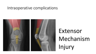 Intraoperative complications
Extensor
Mechanism
Injury
 