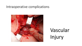 Intraoperative complications
Vascular
Injury
 