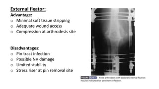External fixator:
Advantage:
o Minimal soft tissue stripping
o Adequate wound access
o Compression at arthrodesis site
Disadvantages:
o Pin tract infection
o Possible NV damage
o Limited stability
o Stress riser at pin removal site
 