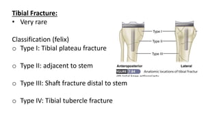 Tibial Fracture:
• Very rare
Classification (felix)
o Type I: Tibial plateau fracture
o Type II: adjacent to stem
o Type III: Shaft fracture distal to stem
o Type IV: Tibial tubercle fracture
 