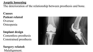Aseptic loosening
The deterioration of the relationship between prosthesis and bone.
Causes
Patient related
Overuse
Osteopenia
Implant design
Cementless prosthesis
Constrained prosthesis
Surgery related:
Malalignment.
 
