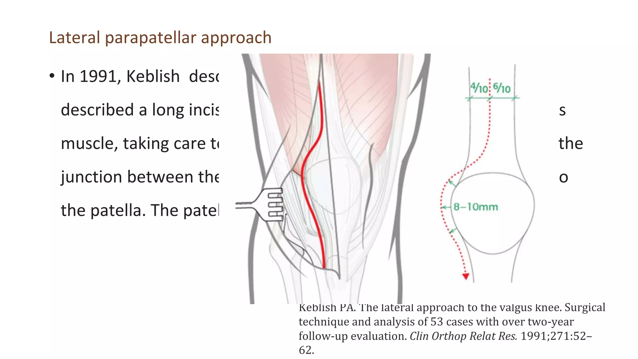 TKA in valgus knee.pptx