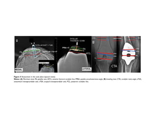 Femur and Tibia Bowing effect on TKR outcomes.pptx