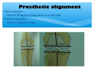 Prosthetic alignment
∗ Tibial component
∗ Placed at 90 degrees to longitudinal axis of tibial shaft
∗ Femoral component
∗ Placed in 6 degrees of valgus
 