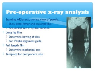 Pre-operative x-ray analysis
 Standing AP, lateral, skyline view of patella
 Show distal femur and proximal tibia
 Anatomical axis in neutral rotation
 Long leg film
 Determine bowing of tibia
 For IM tibia alignment guide
 Full length film
 Determine mechanical axis
 Template for component size
 