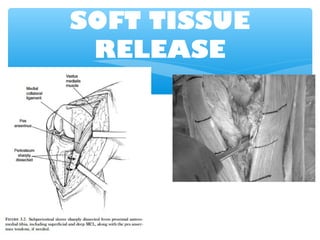 SOFT TISSUE
RELEASE
 
