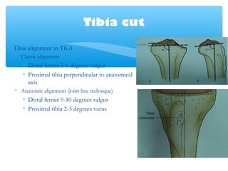 Tibia cut
∗ Tibia alignment in TKA
∗ Classic alignment
∗ Distal femur 5-6 degrees valgus
∗ Proximal tibia perpendicular to anatomical
axis
∗ Anatomic alignment (joint line technique)
∗ Distal femur 9-10 degrees valgus
∗ Proximal tibia 2-3 degrees varus
 
