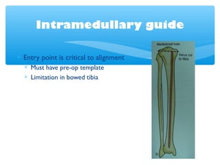 Intramedullary guide
∗ Entry point is critical to alignment
∗ Must have pre-op template
∗ Limitation in bowed tibia
 
