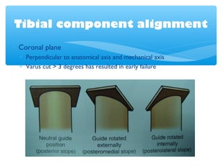 Tibial component alignment
∗ Coronal plane
∗ Perpendicular to anatomical axis and mechanical axis
∗ Varus cut > 3 degrees has resulted in early failure
 