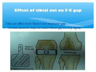 Effect of tibial cut on F-E gap
∗ Tibia cut effect both flexion and extension gap
∗ Increase posterior slope can loosen flexion gap but only slightly
 