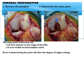 FEMORAL PREPARATION
1. Remove all osteophyt . 2. Determine the entry point
of femoral rod.
The entry point of femoral rod:
. 7-10 mm anterior to the origin of the PCL.
. 3-5 mm medial to intercondylar notch.
Error in determining the point will alter the degree of valgus cutting.
 