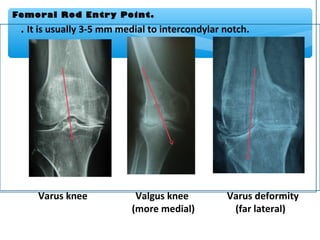Femoral Rod Entry Point.
. It is usually 3-5 mm medial to intercondylar notch.
Varus knee Valgus knee Varus deformity
(more medial) (far lateral)
 