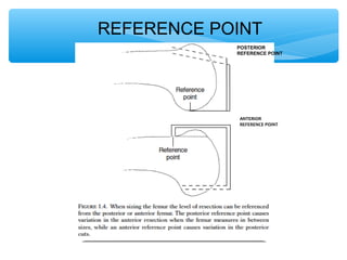 POSTERIOR
REFERENCE POINT
ANTERIOR
REFERENCE POINT
REFERENCE POINT
 