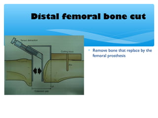 Distal femoral bone cut
∗ Remove bone that replace by the
femoral prosthesis
 