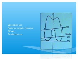 Rotation
alignment
Epicondylar axis
Posterior condylar reference
AP axis
Parallel tibial cut
 