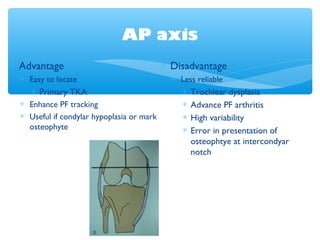 AP axis
∗ Advantage
∗ Easy to locate
∗ Primary TKA
∗ Enhance PF tracking
∗ Useful if condylar hypoplasia or mark
osteophyte
∗ Disadvantage
∗ Less reliable
∗ Trochlear dysplasia
∗ Advance PF arthritis
∗ High variability
∗ Error in presentation of
osteophtye at intercondyar
notch
 