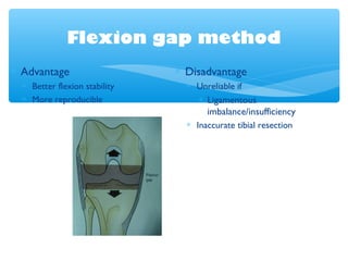 Flexion gap method
∗ Advantage
∗ Better flexion stability
∗ More reproducible
∗ Disadvantage
∗ Unreliable if
∗ Ligamentous
imbalance/insufficiency
∗ Inaccurate tibial resection
 