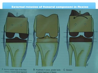 External rotation of femoral component in flexion
 