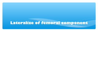 Lateralize of femoral component
 