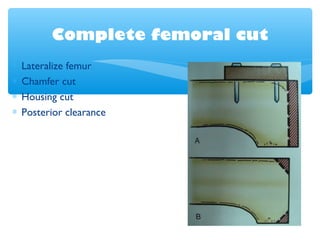 Complete femoral cut
∗ Lateralize femur
∗ Chamfer cut
∗ Housing cut
∗ Posterior clearance
 