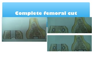 Complete femoral cut
 