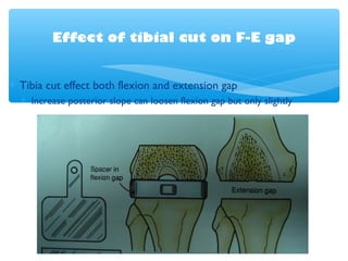 FEMORAL PREPARATION
1. Remove all osteophyt . 2. Determine the entry point
of femoral rod.
The entry point of femoral rod:...