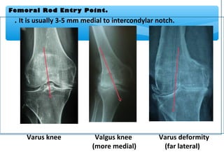 Rotation
alignment
Epicondylar axis
Posterior condylar reference
AP axis
Parallel tibial cut
 