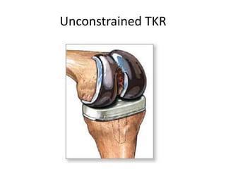 Unconstrained TKR
 