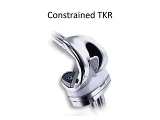 Constrained TKR
 