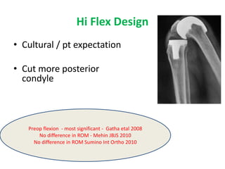 Hi Flex Design
• Cultural / pt expectation
• Cut more posterior
condyle
Preop flexion - most significant - Gatha etal 2008
No difference in ROM - Mehin JBJS 2010
No difference in ROM Sumino Int Ortho 2010
 