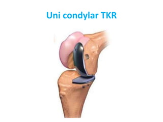 Uni condylar TKR
 