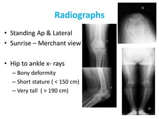 Radiographs
• Standing Ap & Lateral
• Sunrise – Merchant view
• Hip to ankle x- rays
– Bony deformity
– Short stature ( < 150 cm)
– Very tall ( > 190 cm)
 