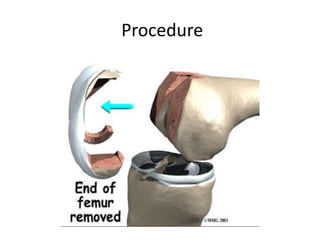 Procedure
 