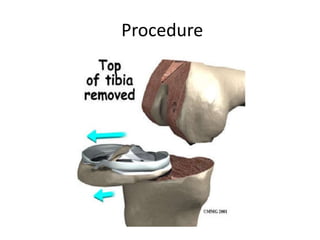 Procedure
 