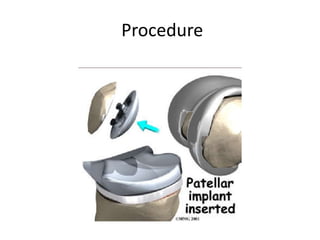 Procedure
 