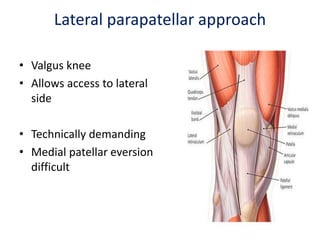 Lateral parapatellar approach
• Valgus knee
• Allows access to lateral
side
• Technically demanding
• Medial patellar eversion
difficult
 