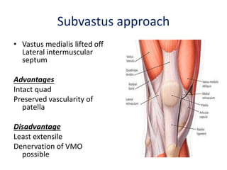 Subvastus approach
• Vastus medialis lifted off
Lateral intermuscular
septum
Advantages
Intact quad
Preserved vascularity of
patella
Disadvantage
Least extensile
Denervation of VMO
possible
 