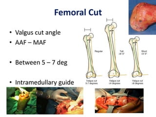 Femoral Cut
• Valgus cut angle
• AAF – MAF
• Between 5 – 7 deg
• Intramedullary guide
 