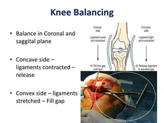 Knee Balancing
• Balance in Coronal and
saggital plane
• Concave side –
ligaments contracted –
release
• Convex side – ligaments
stretched – Fill gap
 