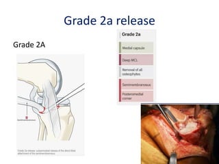 Grade 2a release
Grade 2A
 