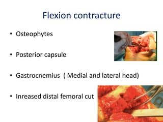 Flexion contracture
• Osteophytes
• Posterior capsule
• Gastrocnemius ( Medial and lateral head)
• Inreased distal femoral cut
 
