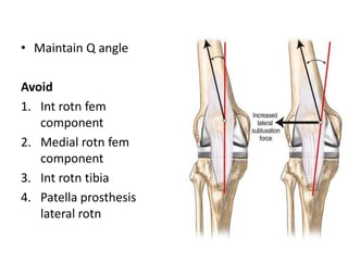 • Maintain Q angle
Avoid
1. Int rotn fem
component
2. Medial rotn fem
component
3. Int rotn tibia
4. Patella prosthesis
lateral rotn
 