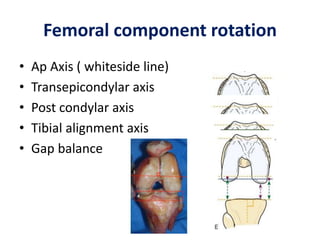 Femoral component rotation
• Ap Axis ( whiteside line)
• Transepicondylar axis
• Post condylar axis
• Tibial alignment axis
• Gap balance
 