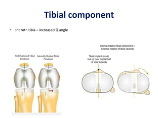 Tibial component
• Int rotn tibia – increased Q angle
 