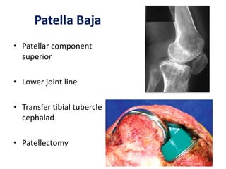 Patella Baja
• Patellar component
superior
• Lower joint line
• Transfer tibial tubercle
cephalad
• Patellectomy
 