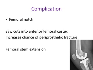 Complication
• Femoral notch
Saw cuts into anterior femoral cortex
Increases chance of periprosthetic fracture
Femoral stem extension
 
