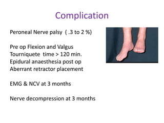 Complication
Peroneal Nerve palsy ( .3 to 2 %)
Pre op Flexion and Valgus
Tourniquete time > 120 min.
Epidural anaesthesia post op
Aberrant retractor placement
EMG & NCV at 3 months
Nerve decompression at 3 months
 