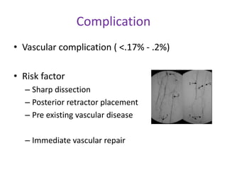Complication
• Vascular complication ( <.17% - .2%)
• Risk factor
– Sharp dissection
– Posterior retractor placement
– Pre existing vascular disease
– Immediate vascular repair
 